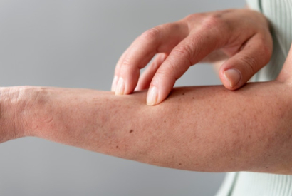 Cómo bajar la inflamación de una picadura de mosquito
